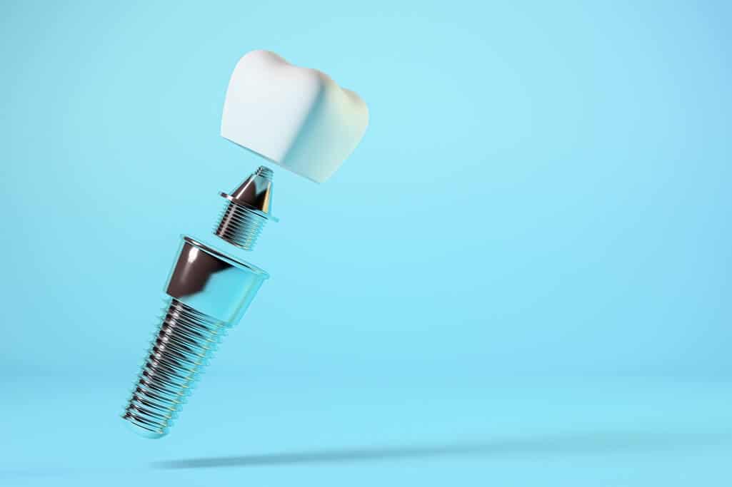 השתלות שיניים ללא ניתוח
