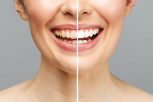 הלבנת שיניים לפני ואחרי 6