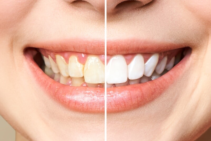 כמה עולה הלבנת שיניים?