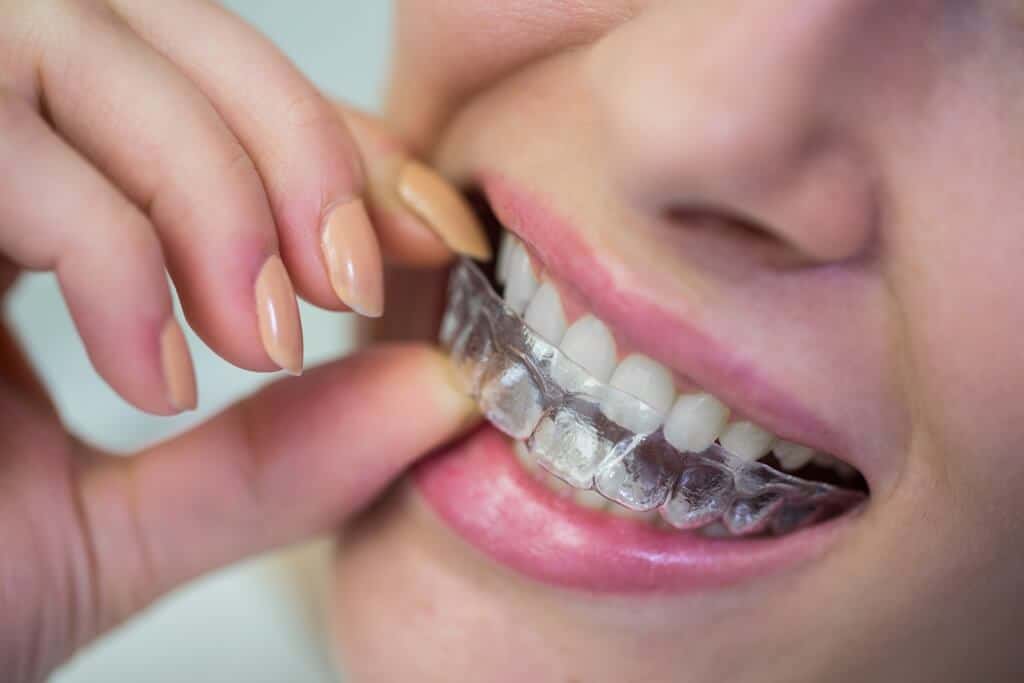 היתרונות של שימוש ביישור שיניים שקוף